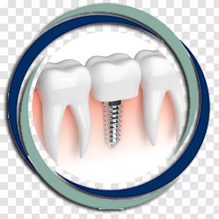 Dental Implant Dentistry Atlanta Center For Health - Dentist - Dr. Bradley Hepler RestorationCrown Transparent PNG