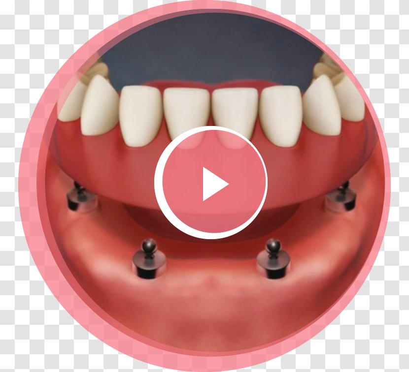Tooth Dental Implant Dentures Removable Partial Denture - Watercolor - Dentistry Transparent PNG