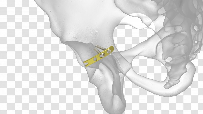 Bone Fracture Acetabulum Acetabular Radius Pelvic - Heart - Frame Transparent PNG