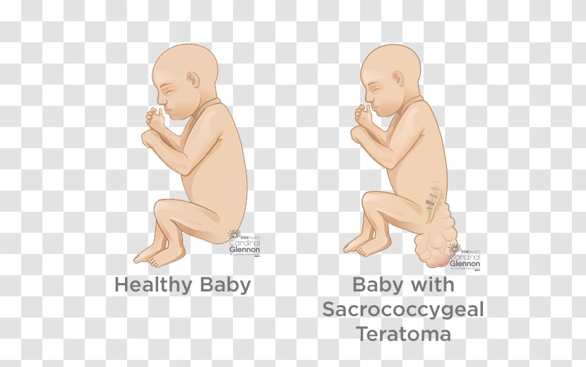 Sacrococcygeal Teratoma Spina Bifida Birth Defect Surgery Vertebral Column - Heart - Diagnosis And Treatment Transparent PNG