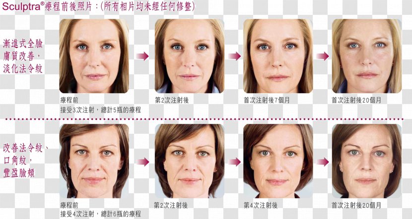 Eyebrow Cheek Nasolabial Fold Botulinum Toxin Forehead - Lip - Nose Transparent PNG