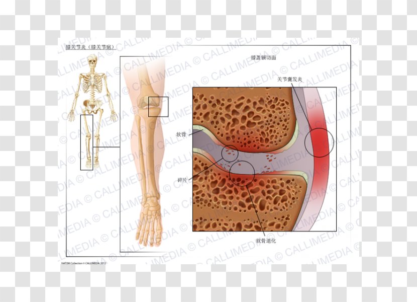 Knee Arthritis Osteoarthritis - Watercolor - Ráº¯n 3d Transparent PNG