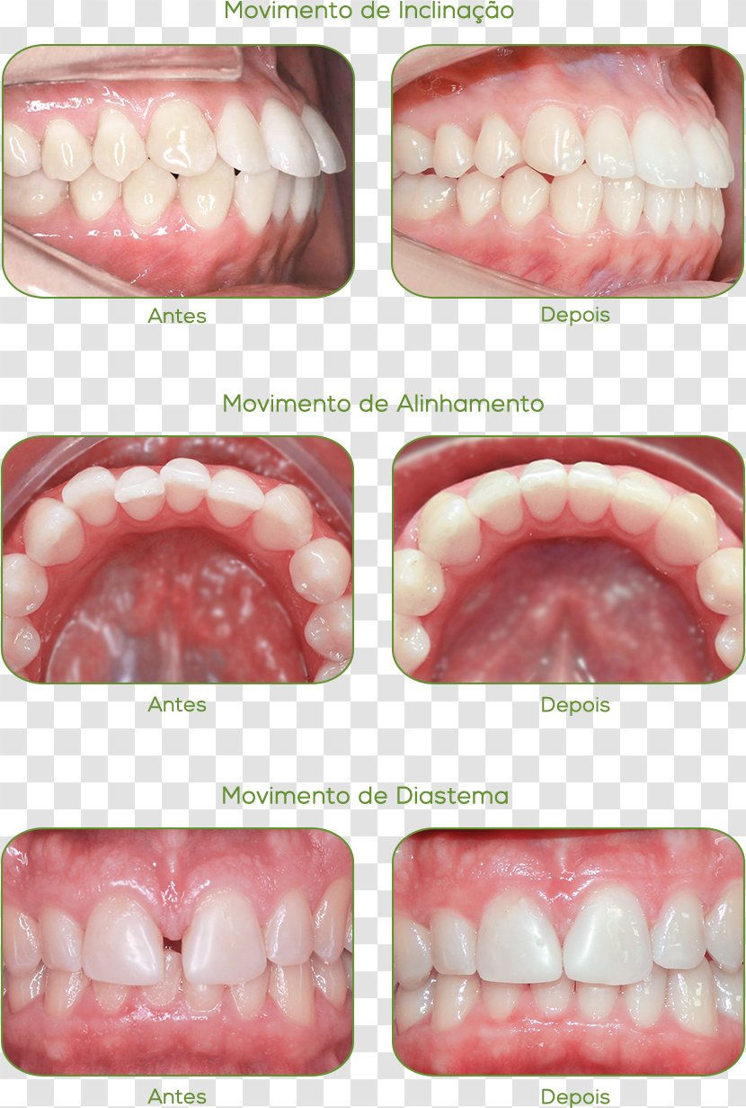 Case Report Jaw Orthodontics Health Acetate - Mouth Transparent PNG