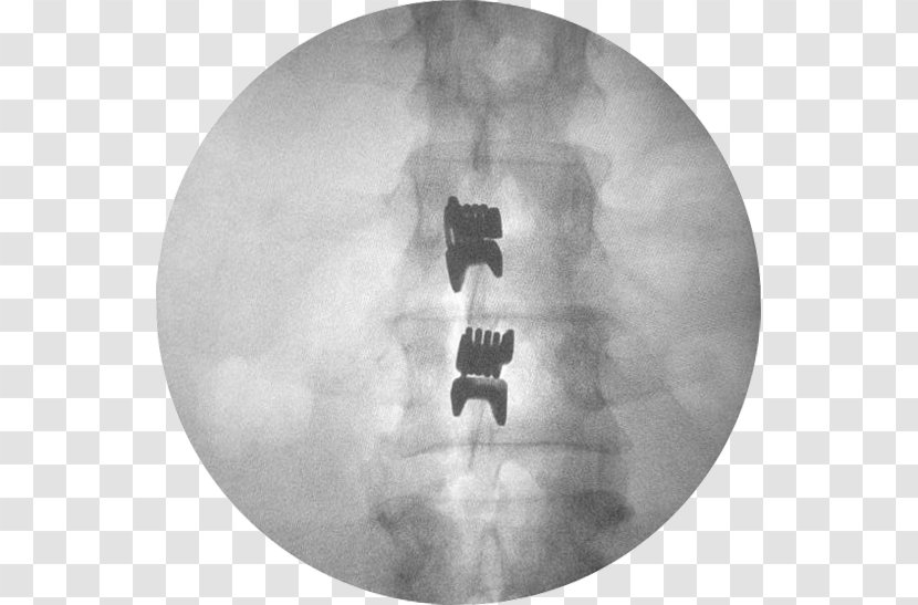 Interspinales Muscles Vertebral Column Spinal Disc Herniation Lumbar Vertebrae - Radiography - Columna Transparent PNG
