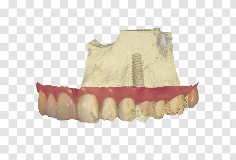 Dental Laboratory Implant Prosthesis Dentistry - Surgery - Virtual Game Transparent PNG