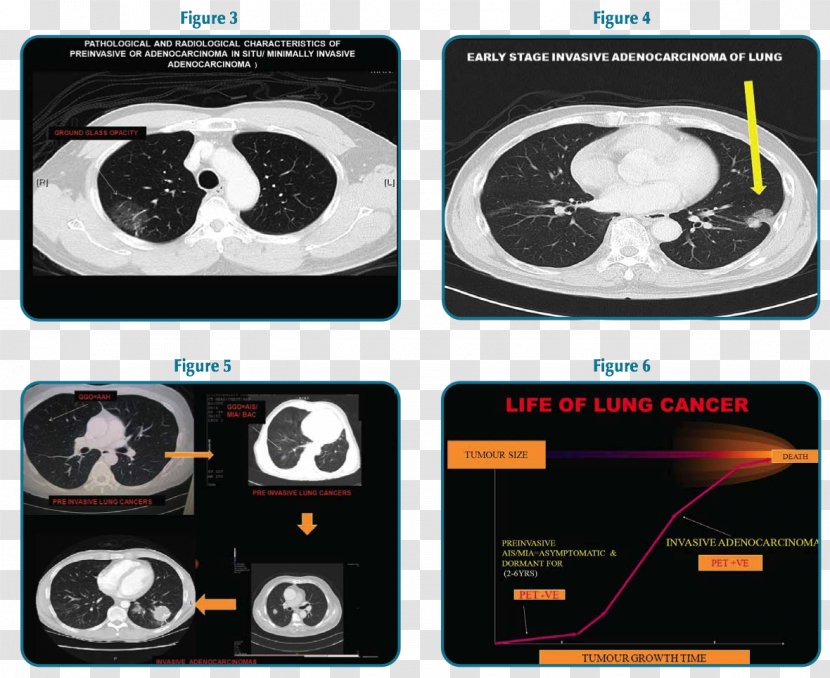 Brand Technology - Multimedia - Lungs Surgery Transparent PNG