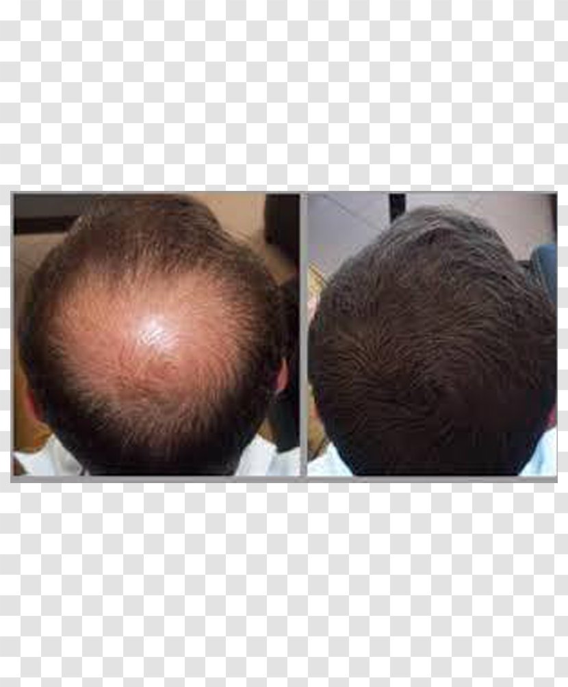 Management Of Hair Loss Care Human Growth - Transplantation Transparent PNG