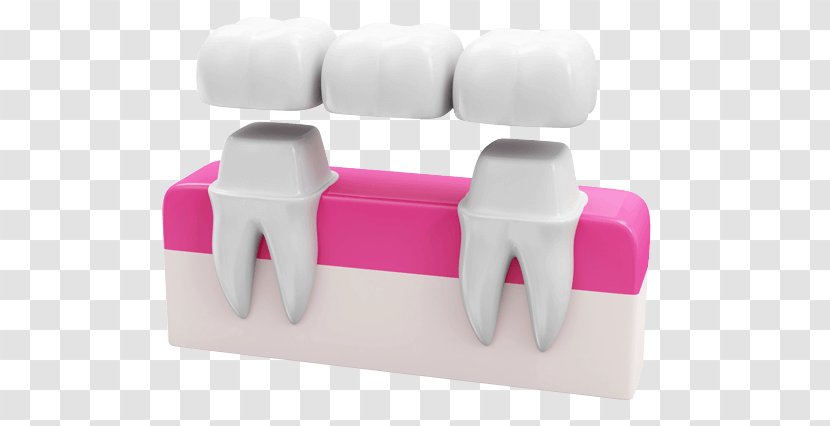 Bridge Dentistry Crown Dental Implant Transparent PNG