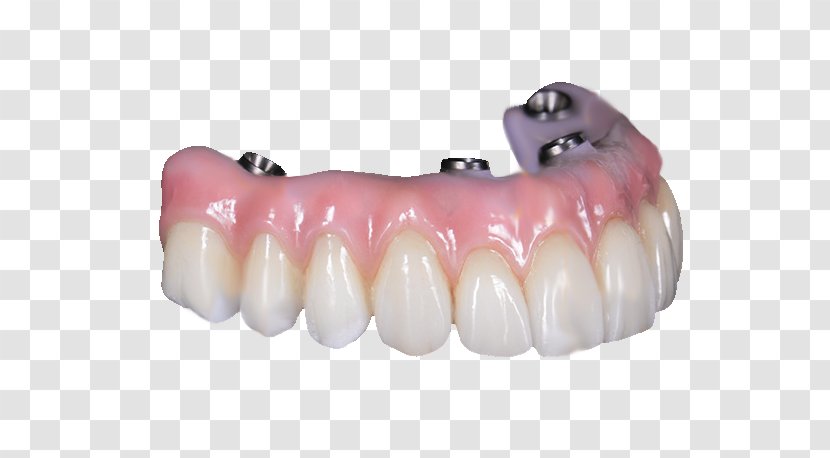 Tooth All-on-4 Dentures Bridge Dental Implant - Ceramic Transparent PNG