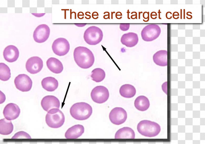 Codocyte Red Blood Cell Film Poikilocytosis - Cavernous Transparent PNG