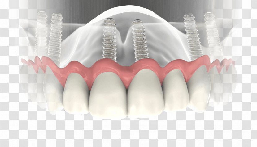 Dental Implant Dentistry Dentures - Tree - Implants Transparent PNG