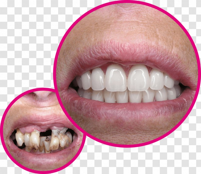 Tooth Bridge Crown Dentist Veneer - Tongue - Bent Frame Transparent PNG