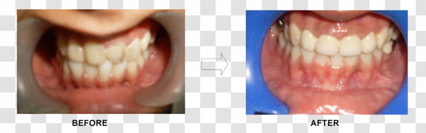 Tooth Dentistry Close-up Ceramco Dental Clinic Borivali - Neck - Smile Transparent PNG