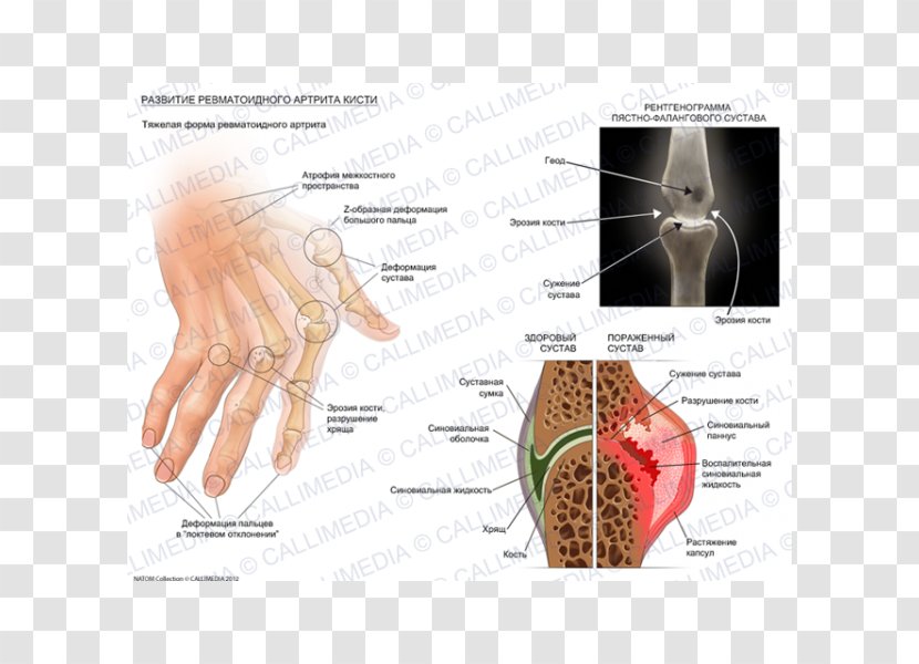 Rheumatoid Arthritis Chronic Childhood Disease Rheumatism - Flower - Hand Grave Transparent PNG