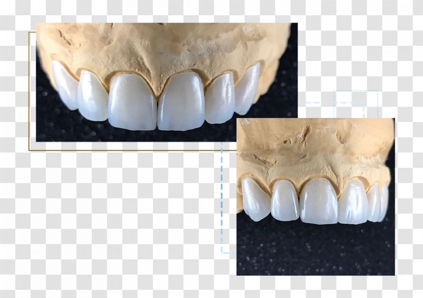 Veneer Porcelain Aesthetics Human Tooth - Frame - Veneers Transparent PNG