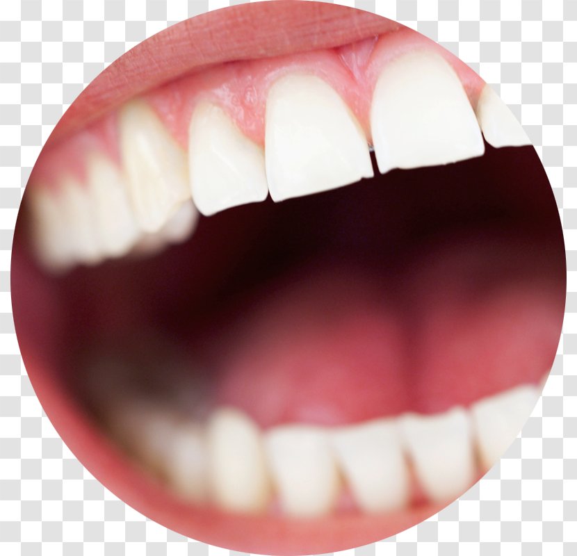 Human Tooth Dental Implant Edentulism Dentistry - Jaw - Surgery Transparent PNG