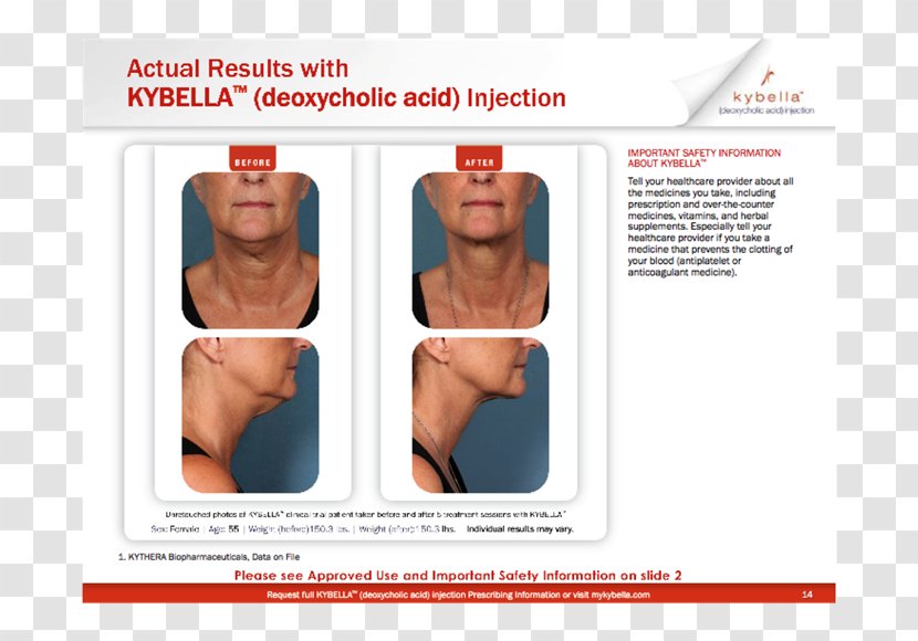 Surgery Deoxycholic Acid Dermatology Chin Submental Triangle - Heart - Nonsurgical Liposuction Transparent PNG