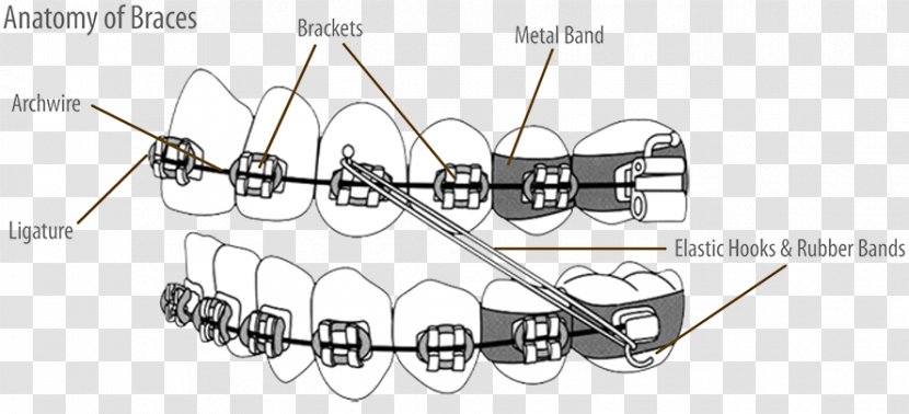 Dental Braces Molar Orthodontics Tooth Orthodontic Archwire - Wire - Auto Part Transparent PNG