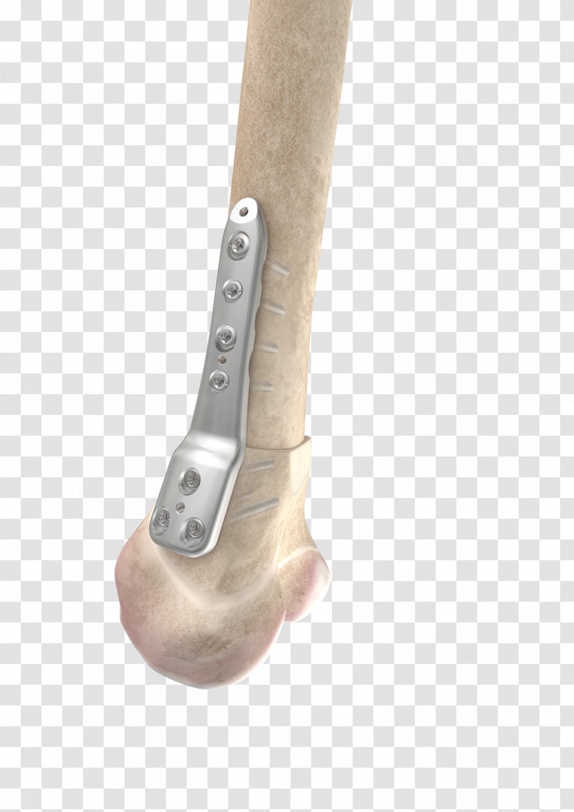 Osteotomy Distal Joint Knee Tibia - Femur Transparent PNG