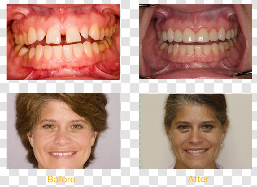 Universal Smiles Dentistry - Tongue - Orlando Cheek MouthOrange Dentist Transparent PNG