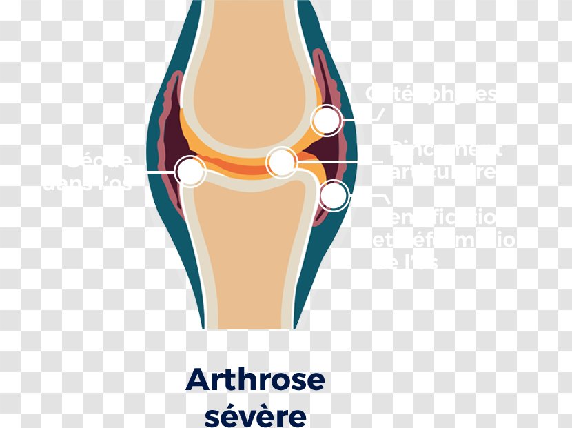 Knee Osteoarthritis Hip Shoulder - Symptom - Cartilage Transparent PNG