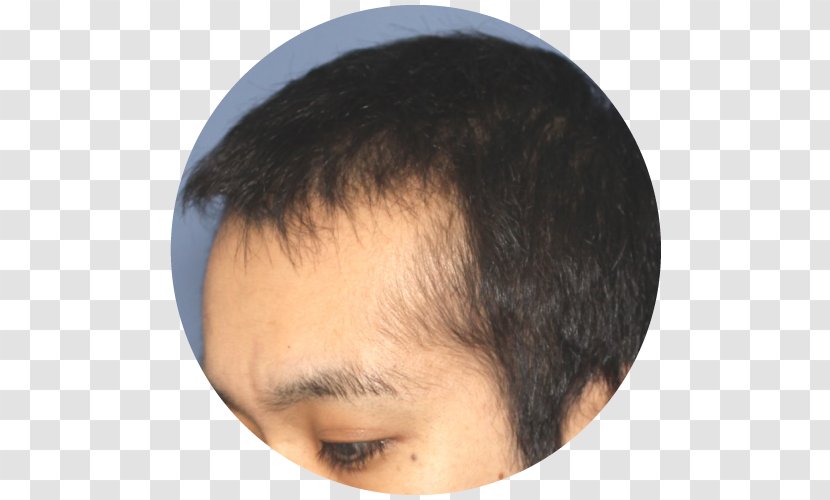 Forehead Management Of Hair Loss Capelli Eyebrow Transparent PNG