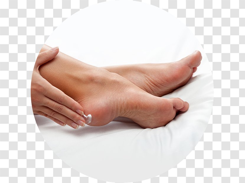 Lotion Diabetic Foot Heel Skin - Tree - Suffer Damage Transparent PNG