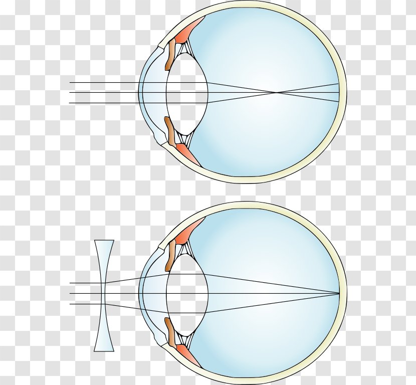 Near-sightedness Hypermetropia Corrective Lens Refractive Error - Eye - Defocused Transparent PNG