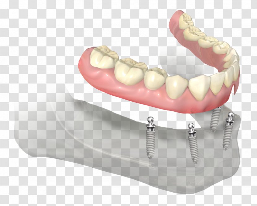 Dentures Dentistry Dental Implant Abutment Prosthesis - Dentist - Teeth Transparent PNG