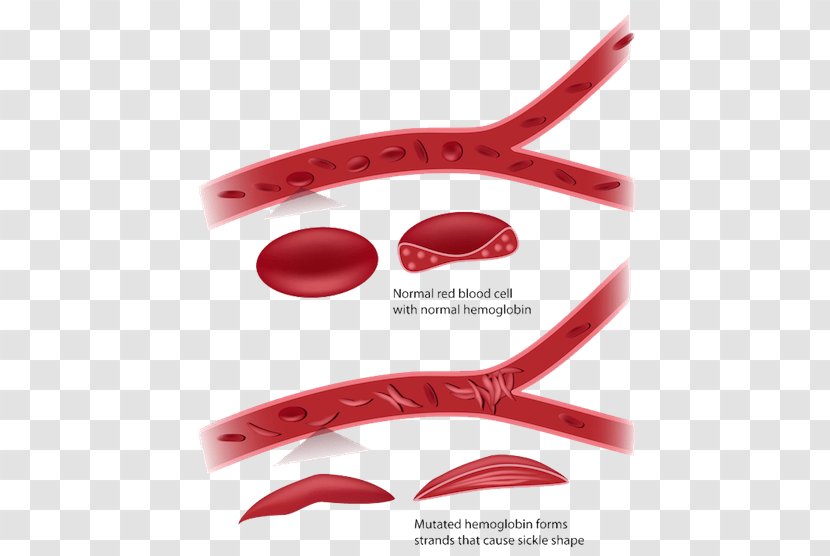 Sickle Cell Disease Red Blood Anemia - Therapy Transparent PNG