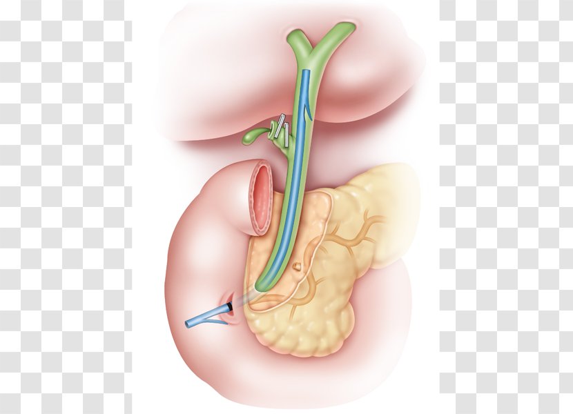 Stenting Common Bile Duct Gallbladder - Flower - Pig Tail Transparent PNG