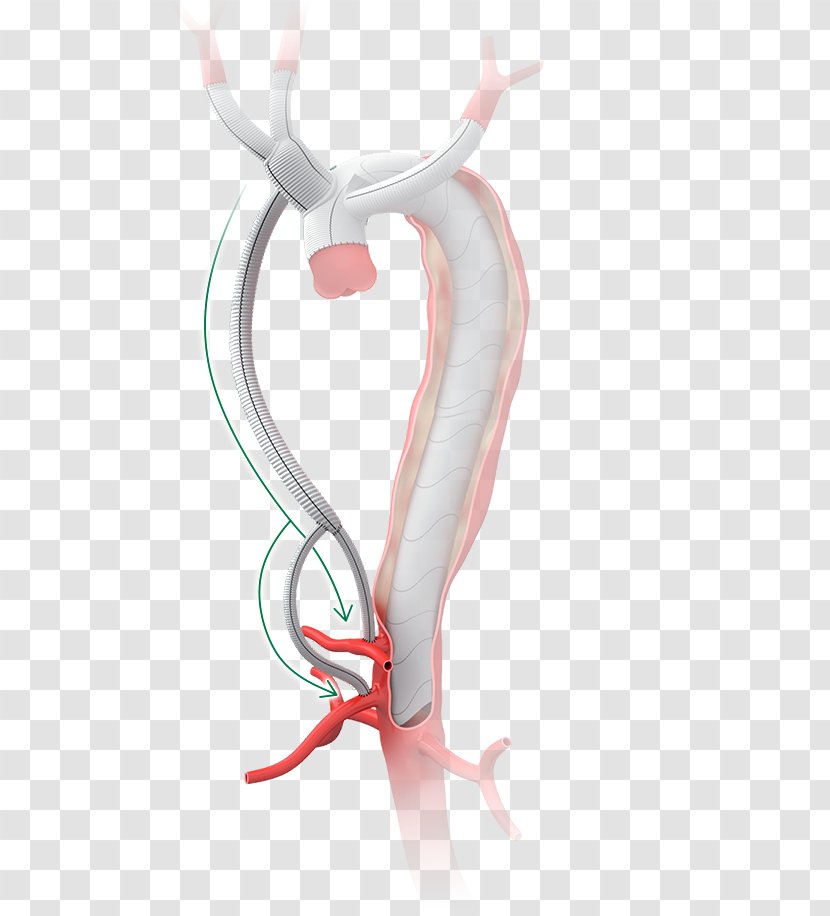 Surgery Graft Aorta Aortic Dissection Anastomosis - Tree - Frame Transparent PNG