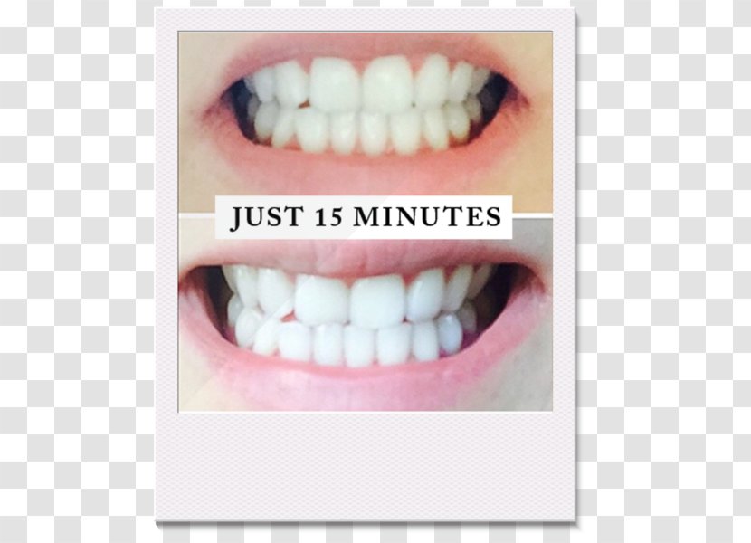 Tooth Whitening Human Laser - Crown - Before And After Transparent PNG