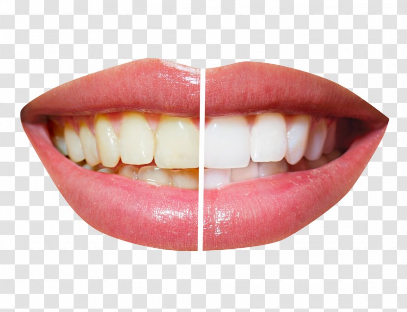 Cosmetic Dentistry Tooth Whitening - Restorative - Teeth Transparent PNG