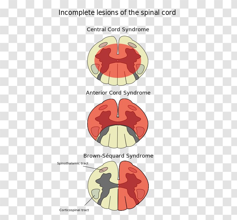 Spinal Cord Injury Anterior Artery Syndrome Central - Cartoon Transparent PNG