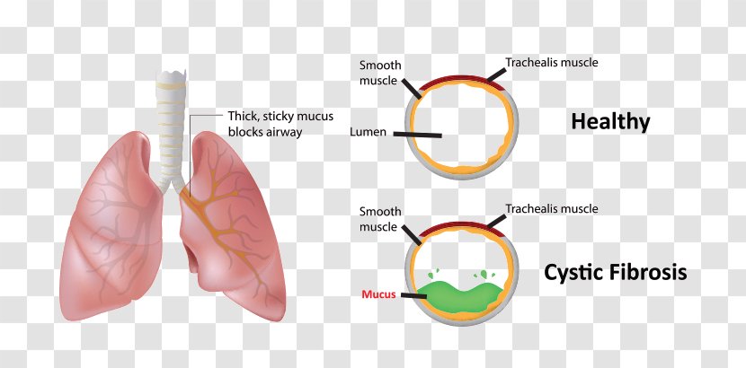 Mucus Blood Hemoptysis Cystic Fibrosis Nose Transparent PNG
