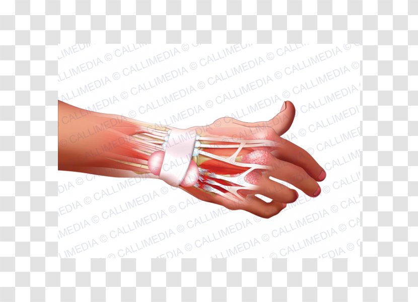 Hand Model Nail Rheumatoid Arthritis Disease - Pathology Transparent PNG