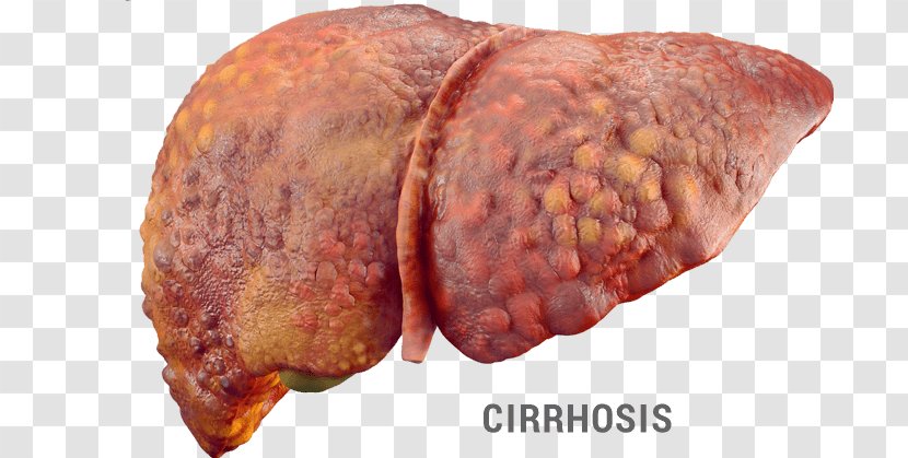 Liver Disease Hepatic Encephalopathy Fatty Hepatitis - Silhouette - Health Transparent PNG