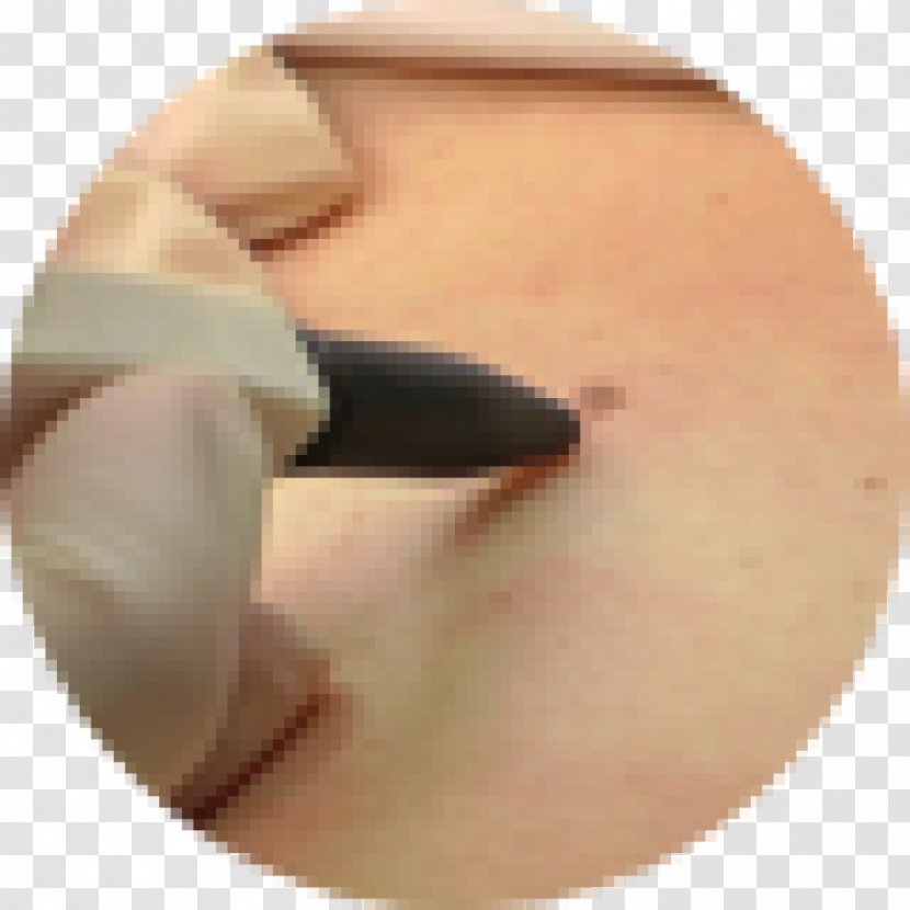 Skin Tag Wart Leicester Laser Clinic LA - Embarrassment Transparent PNG