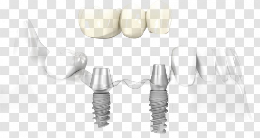 Dental Implant Dentistry Bridge - Dentures Transparent PNG