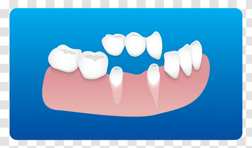 Tooth Dentistry Dental Implant Root Canal - Watercolor - Clinic Card Transparent PNG