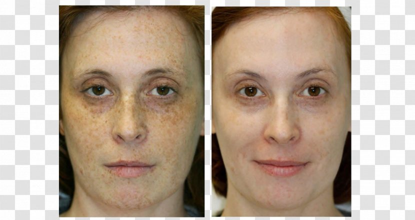 Liver Spot Eyebrow Face Skin Photorejuvenation - Eyelash Transparent PNG