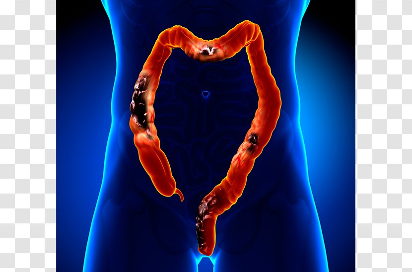 Colorectal Cancer Surgery Large Intestine Polyp - Silhouette - Heart Transparent PNG