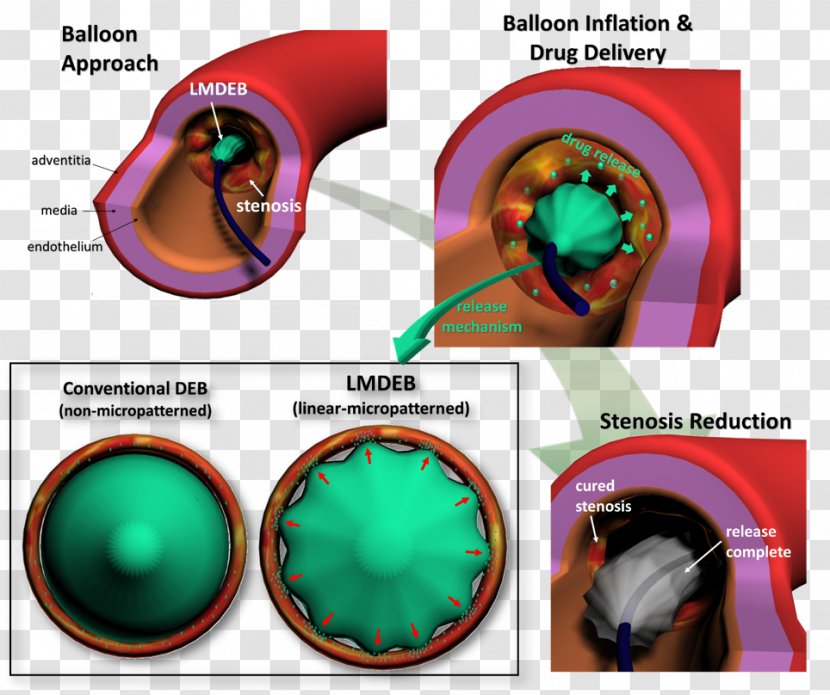 System Biomedical Engineering Publication Drug-eluting Stent Drug Delivery - Lesion - Lee Jung Suk Transparent PNG