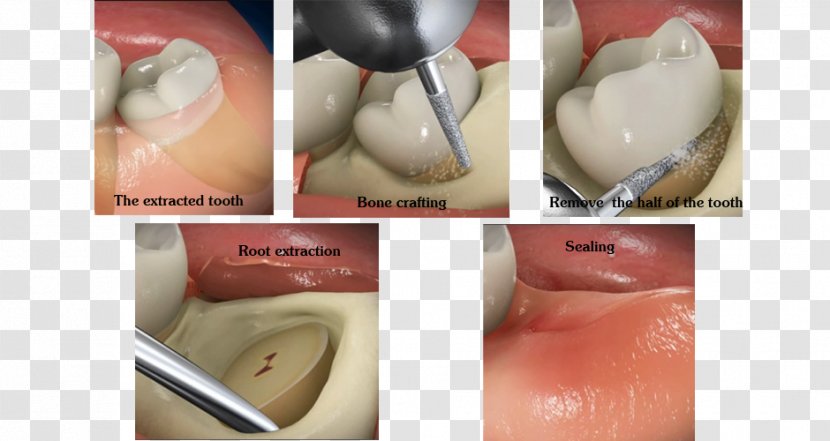 Wisdom Tooth Dental Surgery Dentistry - Bone Fracture - Joint Transparent PNG