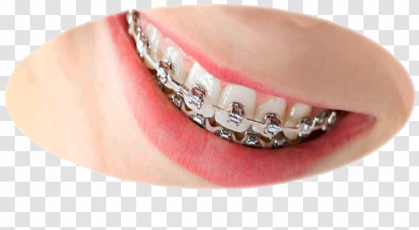 Orthodontics Dental Braces Dentistry - Sugar Skull Transparent PNG