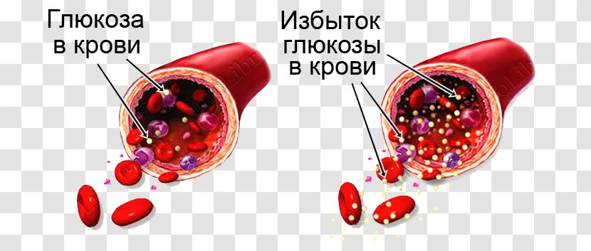 Blood Sugar Hypoglycemia Diabetes Mellitus Hyperglycemia - Glucose Transparent PNG