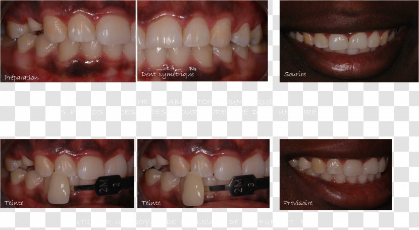 Tooth Premolar Dentistry Incisor Ceramic - Frame - Watercolor Transparent PNG