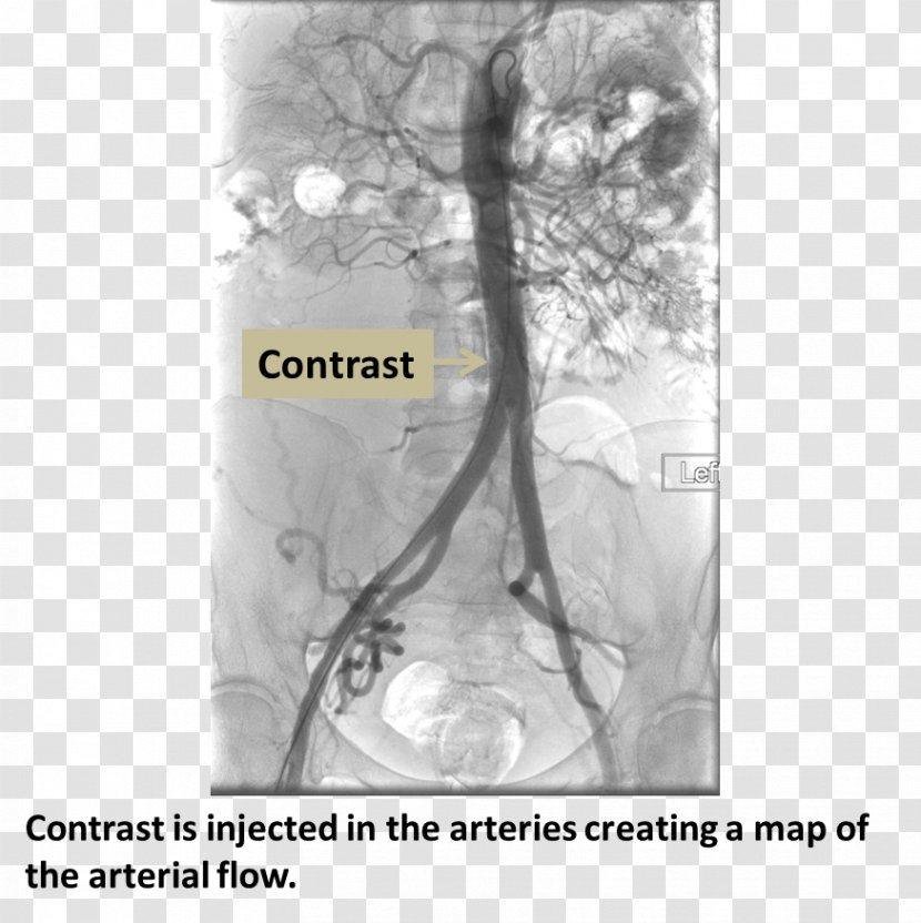 Computed Tomography Angiography Femoral Artery Coronary Catheterization Medical Procedure - Drawing Transparent PNG
