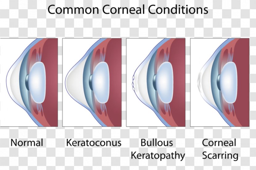 Keratoconus Corneal Limbus Eye Symptom - Sclera Transparent PNG